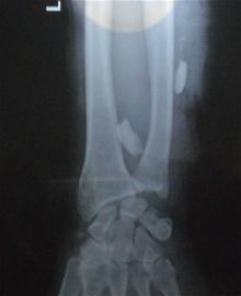 產仔母豬狂咬人不松口