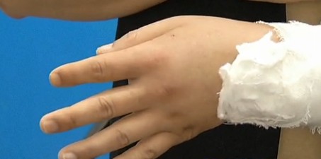 青島廚師剔骨頭砍到手血如噴泉 手筋砍斷血沾滿出租 青島廚師剔骨頭砍到手血如噴泉 手筋砍斷血沾滿出租