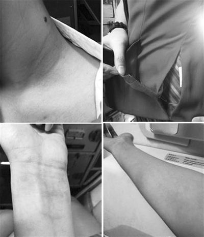 南航一空姐被打后,稱其手部淤青,身上有多處撓痕。